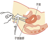 腟鏡診